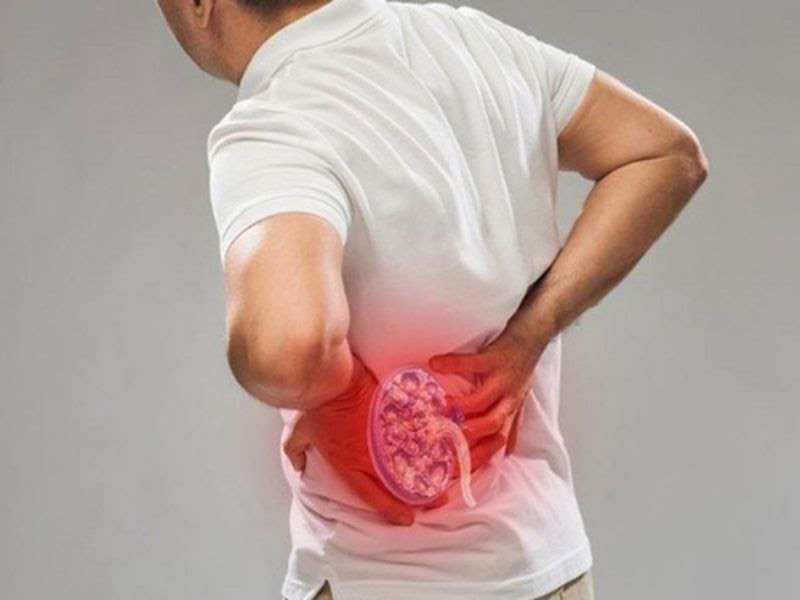 Sỏi thận, suy thận… cũng có thể gây đau lưng bên trái phía dưới